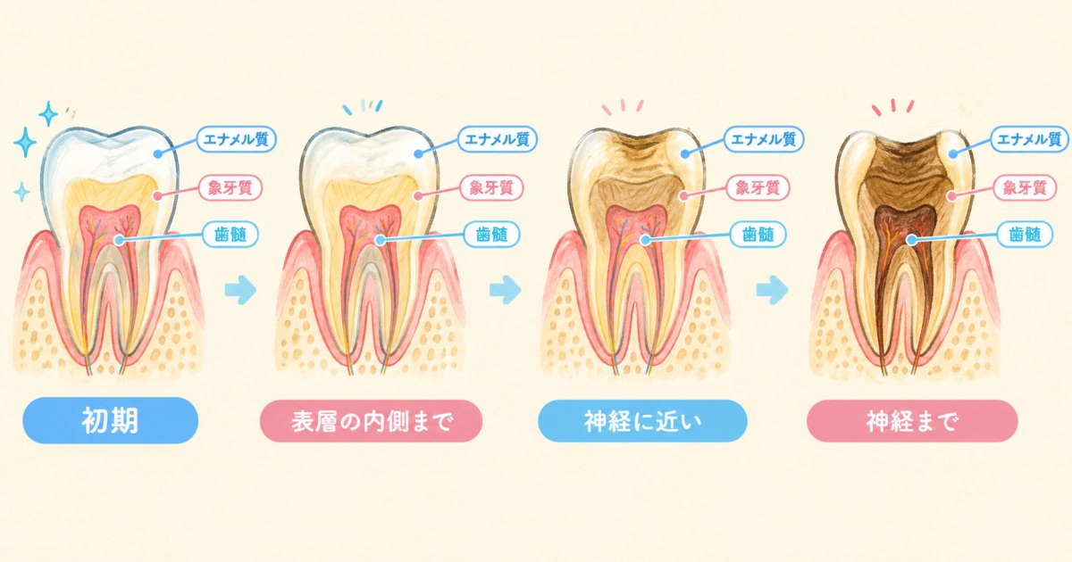 むし歯が神経まで進む仕組みと段階の見分け方